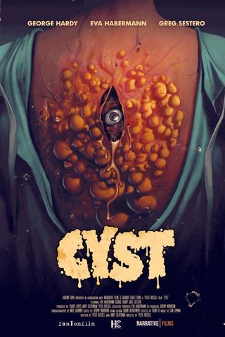 Cyst